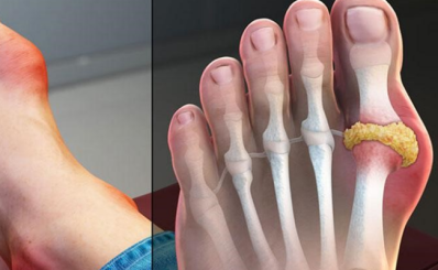 Bệnh gout nên ăn gì và kiêng ăn gì?