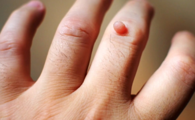 Mụn cóc: triệu chứng, nguyên nhân, điều trị và dự phòng