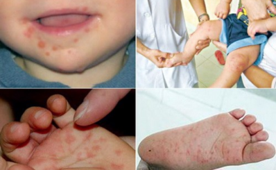 (HCDC) - Cảnh báo: Số ca bệnh Tay chân miệng đang có chiều hướng gia tăng