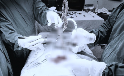 (HCDC) Cảnh giác hành vi tự ăn tóc ở trẻ em