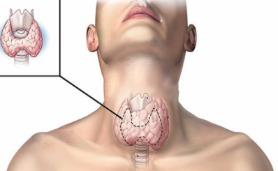Bướu cổ: nguyên nhân, dấu hiệu, điều trị, phòng ngừa
