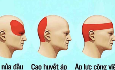 Các bệnh đau đầu nguy hiểm: dấu hiệu, nguyên nhân, chẩn đoán, xét nghiệm, điều trị