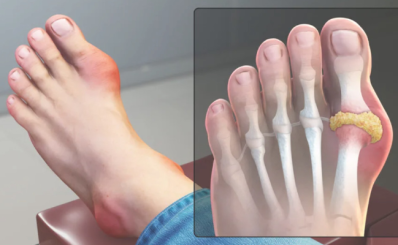 Bệnh gút: dấu hiệu, nguyên nhân, điều trị, dự phòng