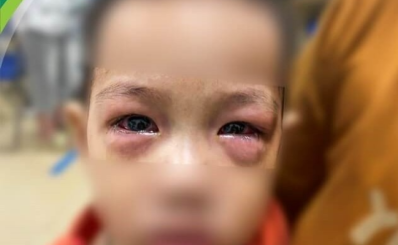 Trẻ mắc bệnh đau mắt đỏ tăng, bác sĩ khuyến cáo cách phòng ngừa