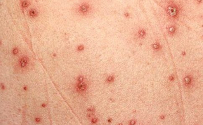 Thủy đậu: Triệu chứng, cách chăm sóc và phòng bệnh
