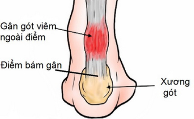 Viêm gân gót chân (Viêm gân Achilles)