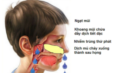 Làm sao phát hiện viêm VA ở trẻ?