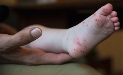Đã xác định subgenotype của Enterovirus 71 gây bệnh tay chân miệng nặng ở trẻ em