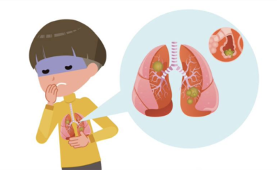 Tác nhân gây viêm hô hấp cấp tính trên trẻ em tại TPHCM vẫn là các virus phổ biến có từ nhiều năm qua.