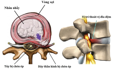 Thoát vị đĩa đệm