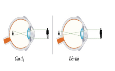 Tật khúc xạ: dấu hiệu, nguyên nhân, chẩn đoán, điều trị, phòng tránh