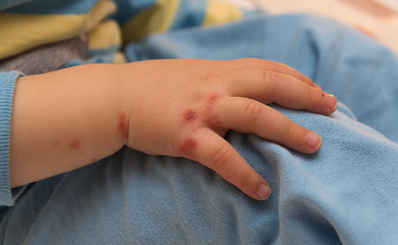 Bệnh cái ghẻ (Scabies)