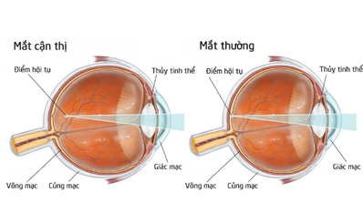 Cận thị là gì?