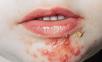 Bệnh chốc (impetigo)