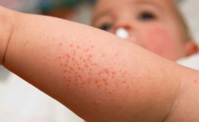 Bệnh sởi và cách, phòng chống bệnh sởi