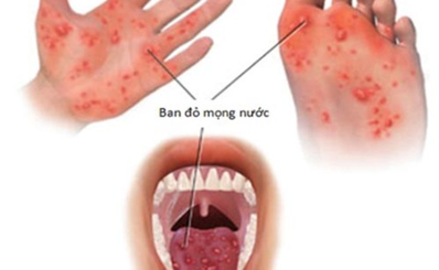 Tay chân miệng: phòng bệnh hơn chữa bệnh