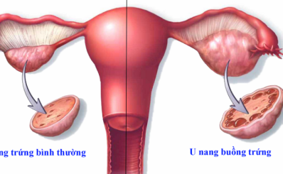 U nang buồng trứng: từ nguyên nhân, triệu chứng đến chẩn đoán và điều trị