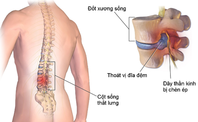 Các bài tập giảm đau lưng