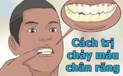 Cách trị chảy máu chân răng