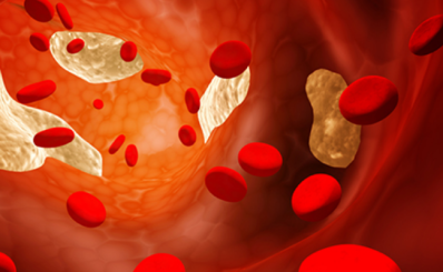 Cholesterol (mỡ máu) là gì? Những biến chứng nguy hiểm