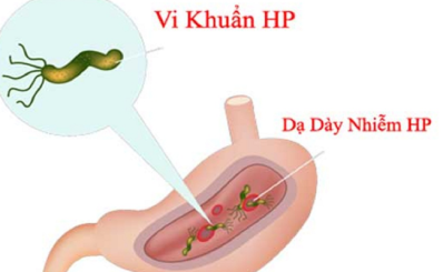 Viêm loét dạ dày: dấu hiệu, nguyên nhân, điều trị và phòng ngừa