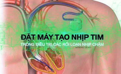 Đặt máy tạo nhịp tim trong điều trị rối loạn nhịp tim chậm