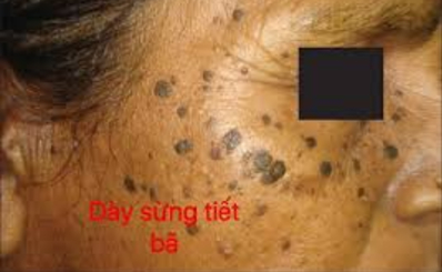 DÀY SỪNG TIẾT BÃ