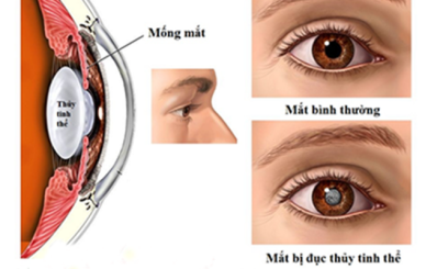 Bệnh đục thủy tinh thể là gì: dấu hiệu, nguyên nhân, chữa trị