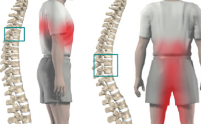 Gai cột sống: nguyên nhân, điều trị, dấu hiệu và cách phòng ngừa