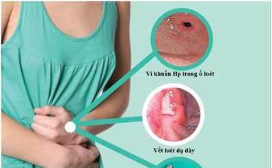 Phòng ngừa viêm loét dạ dày-tá tràng