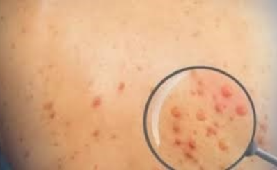 Thông tin báo chí Chủ động phòng, chống dịch bệnh đậu mùa khỉ tại Việt Nam