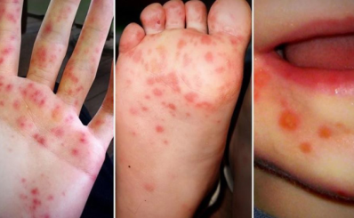 TP.HCM: Tình hình dịch bệnh tuần 22 (từ ngày 29/05/2023 đến ngày 04/06/2023)
