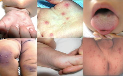 Enterovirus 71 gây bệnh tay chân miệng nặng ở trẻ em đã xuất hiện trở lại