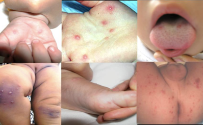 Enterovirus 71 gây bệnh tay chân miệng nặng ở trẻ em đã xuất hiện trở lại