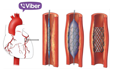 Hội chẩn nhanh qua Viber kịp thời cứu sống bệnh nhân bị nhồi máu cơ tim