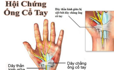 Hội chứng ống cổ tay (hội chứng đường hầm cổ tay): nguyên nhân, dấu hiệu, phòng ngừa, cách điều trị
