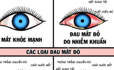 Bệnh đau mắt đỏ: dấu hiệu triệu chứng, nguyên nhân, chẩn đoán, điều trị và dự phòng