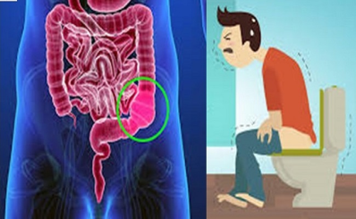 Táo bón: dấu hiệu, nguyên nhân, điều trị hiệu quả ở người lớn, trẻ em