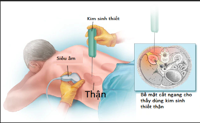Người suy thận kiêng ăn gì?