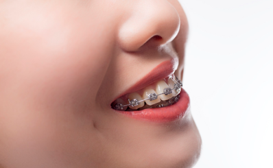 Độ tuổi nào thích hợp để niềng răng?