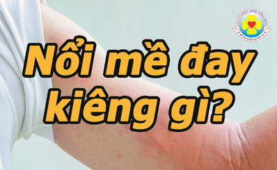 Nổi mề đay kiêng gì?