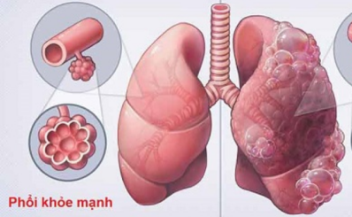 Triệu chứng tức ngực, khó thở, hụt hơi, tim đập nhanh là bệnh gì?