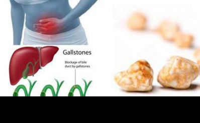 Sỏi túi mật