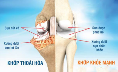 Thoái hóa khớp: dấu hiệu, nguyên nhân, điều trị và cách phòng ngừa