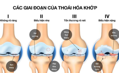 Thoái hóa khớp gối có chữa được không?