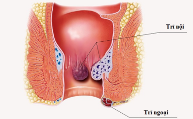Bệnh trĩ: triệu chứng, nguyên nhân, điều trị và cách phòng ngừa