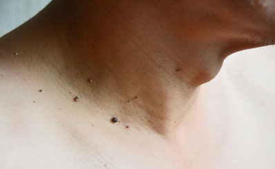 U MỀM TREO (Acrochordon, cutaneous papilloma, skin tag)