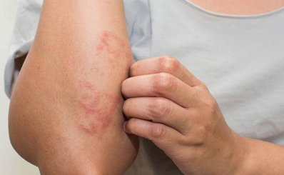 Viêm da cơ địa là gì? Triệu chứng, nguyên nhân, biến chứng, phòng ngừa