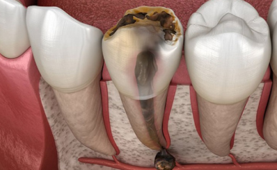 Đau nhức răng: nguyên nhân, phương pháp điều trị hiện đại, phòng ngừa hiệu quả