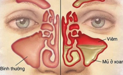 Bệnh viêm xoang: triệu chứng, nguyên nhân, điều trị và dự phòng